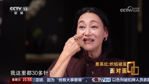 惠英红近日接受央视访问，表示脸上曾缝89针。